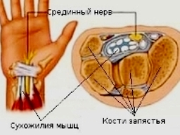 Синдром запястного канала (туннельный синдром запястья)