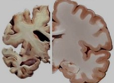 Семейная история болезни Альцгеймера связана с патологией мозга